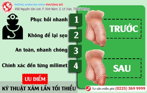Lợi ích khi cắt bao quy đầu bằng kỹ thuật xâm lấn tối thiểu Ưu điểm cắt bao quy đầu