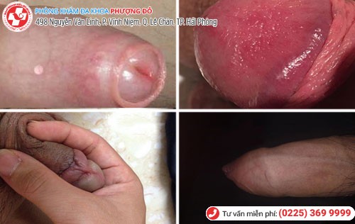 Các vấn đề liên quan đến bao quy đầu thường gặp Các vấn đề thường gặp ở bao quy đầu