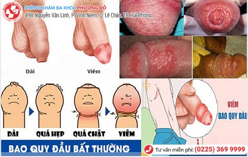 viêm bao quy đầu