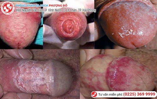 biểu hiện viêm dương vật