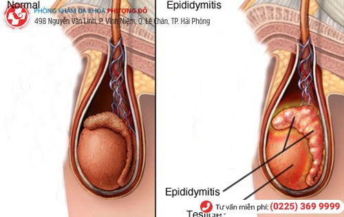 Viêm mào tinh hoàn tăng nguy cơ bị tràn dịch tinh hoàn Viêm mào tinh hoàn tăng nguy cơ bị tràn dịch tinh hoàn
