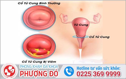 Viêm cổ tử cung