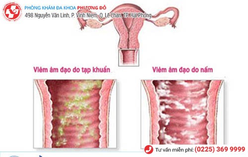 Biểu hiện viêm âm đạo