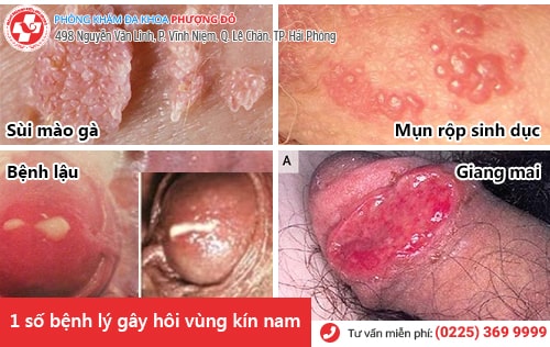 hôi vùng kín