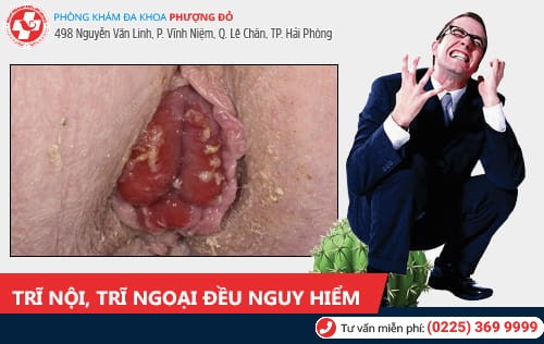 Cách phân biệt trĩ nội trĩ ngoại đơn giản, chính xác nhất Cách phân biệt trĩ nội trĩ ngoại đơn giản, chính xác nhất