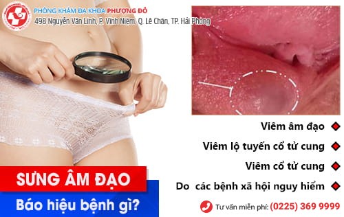 Cảnh giác với hiện tượng sưng âm đạo Cảnh giác với hiện tượng sưng âm đạo