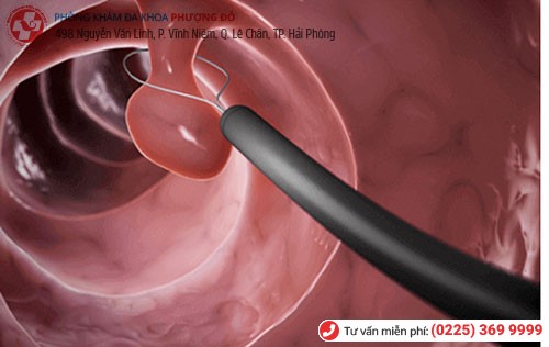 Cắt Polyp cổ tử cung bằng công nghệ dao LEEP Cắt Polyp cổ tử cung bằng công nghệ dao LEEP