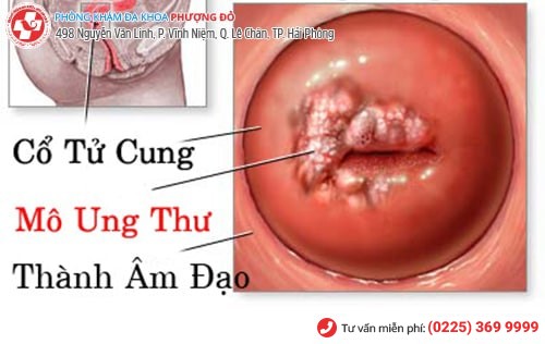 Tổn thương cổ tử cung gây nhiều biến chứng nguy hiểm Tổn thương cổ tử cung gây nhiều biến chứng nguy hiểm