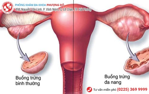 Đa nang buồng trứng
