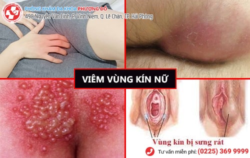dấu hiệu viêm vùng kín nữ