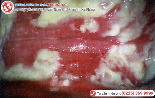 Đau vùng kín là dấu hiệu của bệnh gì? Đau vùng kín là dấu hiệu của bệnh gì?