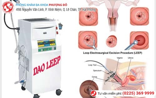 Dao LEEP là công nghệ chữa viêm cổ tử cung hiệu quả hiện nay Dao LEEP là công nghệ chữa viêm cổ tử cung hiệu quả hiện nay