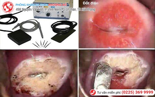Đốt điện viêm lộ tuyến phù hợp với các trường hợp bệnh nhẹ Đốt điện viêm lộ tuyến phù hợp với các trường hợp bệnh nhẹ