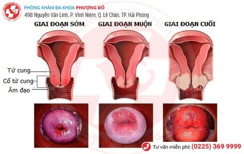 Giai đoạn bệnh viêm lộ tuyến Giai đoạn bệnh viêm lộ tuyến