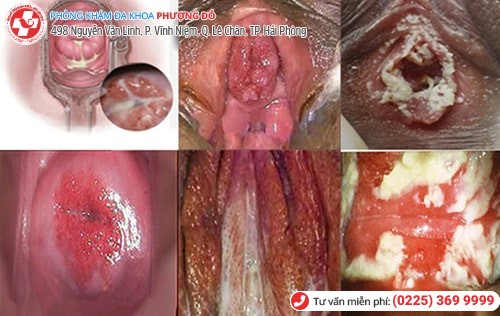 Đau buốt vùng kín do bệnh lậu Đau buốt vùng kín do bệnh lậu