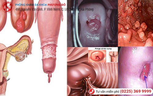 Hình ảnh Polyp cổ tử cung Hình ảnh Polyp cổ tử cung