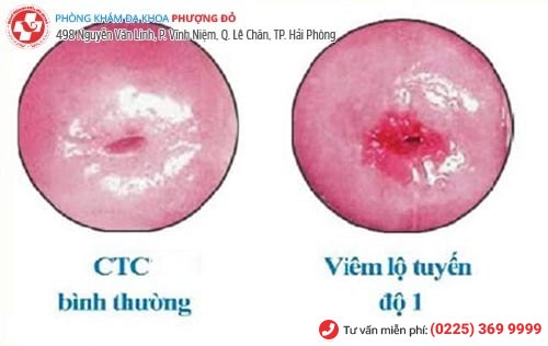 Hình ảnh viêm lộ tuyến cổ tử cung Hình ảnh viêm lộ tuyến cổ tử cung