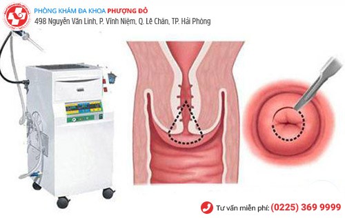 kỹ thuật dao LEEP kỹ thuật dao LEEP