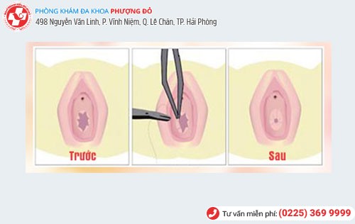 Khâu màng trinh Khâu màng trinh