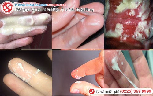 Khí hư màu trắng là dấu hiệu nhiều bệnh nguy hiểm Khí hư màu trắng là dấu hiệu nhiều bệnh nguy hiểm