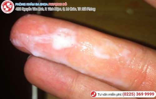 khí hư có màu trắng
