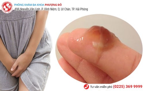 Ra khí hư màu nâu là dấu hiệu bệnh gì? Ra khí hư màu nâu là dấu hiệu bệnh gì?