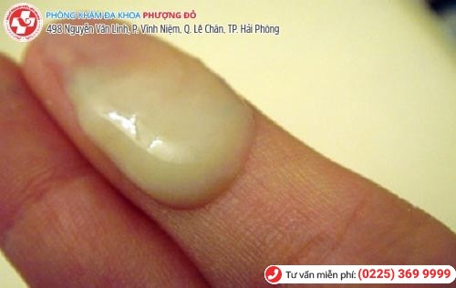 Khí hư màu vàng là dấu hiệu nhiều bệnh nguy hiểm Khí hư màu vàng là dấu hiệu nhiều bệnh nguy hiểm