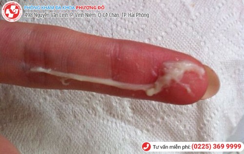 khí hư trắng đục