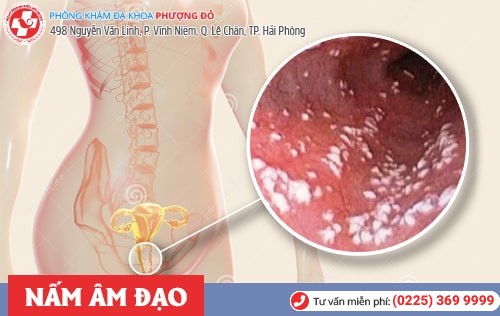 Chia sẻ kinh nghiệm chữa nấm âm đạo Chia sẻ kinh nghiệm chữa nấm âm đạo