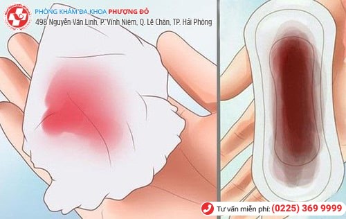 Máu kinh ra nhiều có thể gây vô sinh ở nữ giới Máu kinh ra nhiều có thể gây vô sinh ở nữ giới