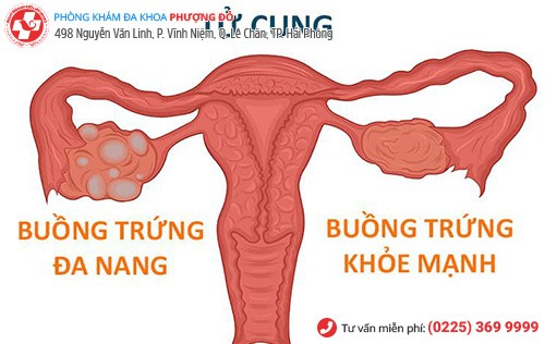 Mất kinh do nguyên nhân nào gây ra? Mất kinh do nguyên nhân nào gây ra?