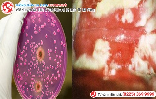 Hình ảnh nấm âm đạo Hình ảnh nấm âm đạo