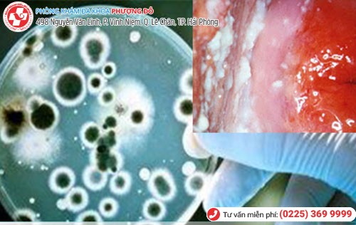 Nấm vùng kín do nhiều nguyên nhân gây nên Nấm vùng kín do nhiều nguyên nhân gây nên