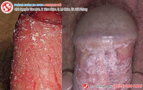 Nấm vùng kín ở nam, nữ - dấu hiệu nhiều bệnh nguy hiểm