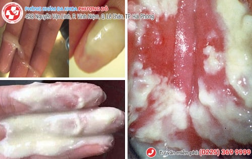Nấm vùng kín ở nam, nữ - dấu hiệu nhiều bệnh nguy hiểm