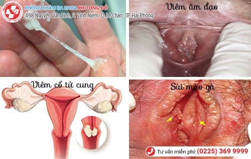 ngứa vùng kín là biểu hiện của bệnh gì ngứa vùng kín là biểu hiện của bệnh gì