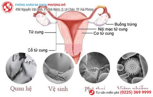 nguyên nhân viêm buồng trứng