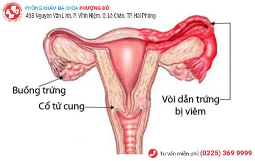 Các nguyên nhân gây bệnh viêm vòi trứng Nguyên nhân viêm vòi trứng