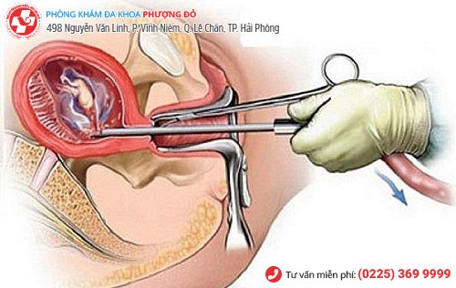 Phá thai không an toàn sẽ đê lại sẹo ở tử cung Phá thai không an toàn sẽ đê lại sẹo ở tử cung