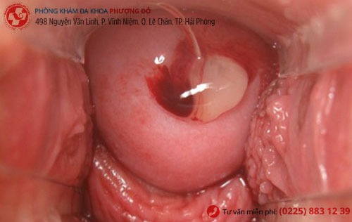 Hình ảnh Polyp cổ tử cung Hình ảnh Polyp cổ tử cung