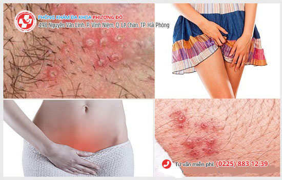 Nhiều trường hợp quan hệ bị ngứa được Phòng Khám Phượng Đỏ tiếp nhận Nhiều trường hợp quan hệ bị ngứa được Phòng Khám Phượng Đỏ tiếp nhận