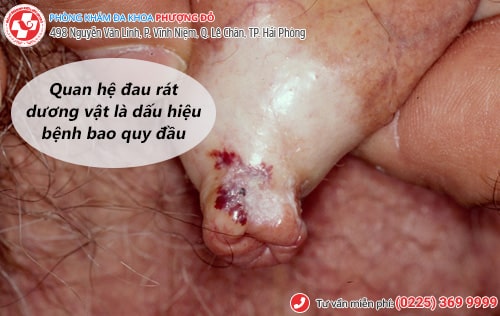 Quan hệ đau rát nam, nữ là bệnh gì? Chữa trị bằng phương pháp nào?