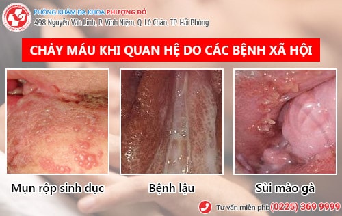 Không nên bỏ qua dấu hiệu quan hệ ra máu ở nam, nữ
