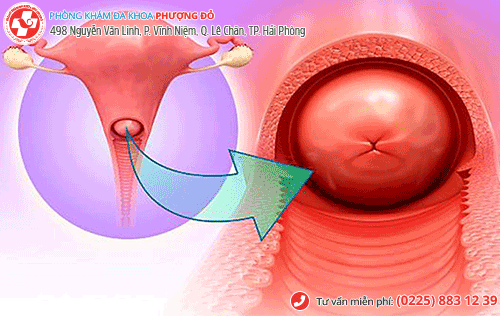 Ra huyết trắng vón cục có thể do viêm cổ tử cung Ra huyết trắng vón cục có thể do viêm cổ tử cung