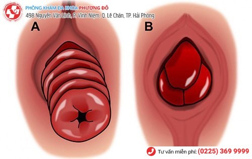 Hình ảnh tử cung bị sa xuống Hình ảnh tử cung bị sa xuống