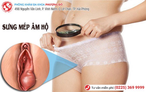Nguyên nhân sưng mép âm hộ Sưng mép âm hộ