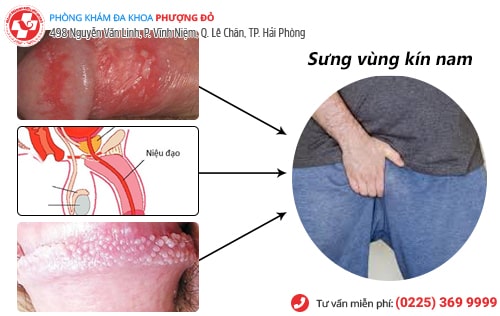 sưng vùng kín