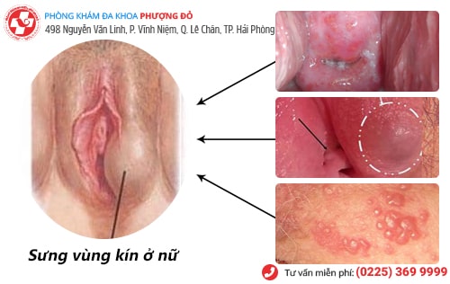 sưng vùng kín