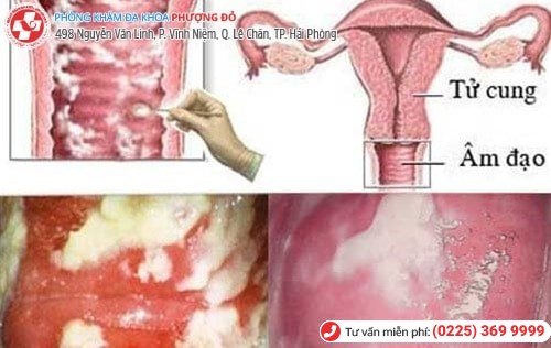 Những tác hại nghiêm trọng nếu không điều trị bệnh phụ khoa Những tác hại nghiêm trọng nếu không điều trị bệnh phụ khoa