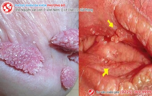 Thịt thừa vùng kín nam, nữ là bị bệnh gì?